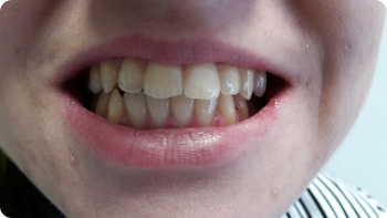 Bielenie zubov s bieliacim gélom Opalescence PF 16%, počiatočný stav