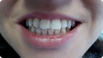 Bielenie zubov s bieliacim gélom Opalescence PF 16%, stav po dvoch týždňoch aplikácie
