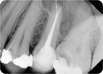intraorálny rtg snímok po zaplnení koreňového kanálika