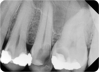 intraorálny rtg snímok pred zaplnenim koreňového kanálika