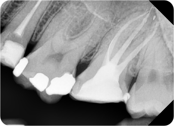 intraorálny rtg snímok pred zaplnenim koreňového kanálika