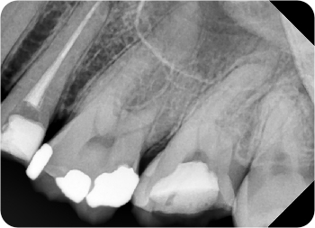 intraorálny rtg snímok pred zaplnenim koreňového kanálika