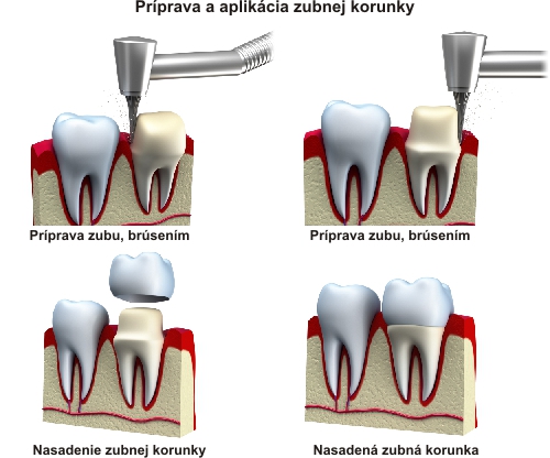 Príprava a aplikácia zubnej korunky